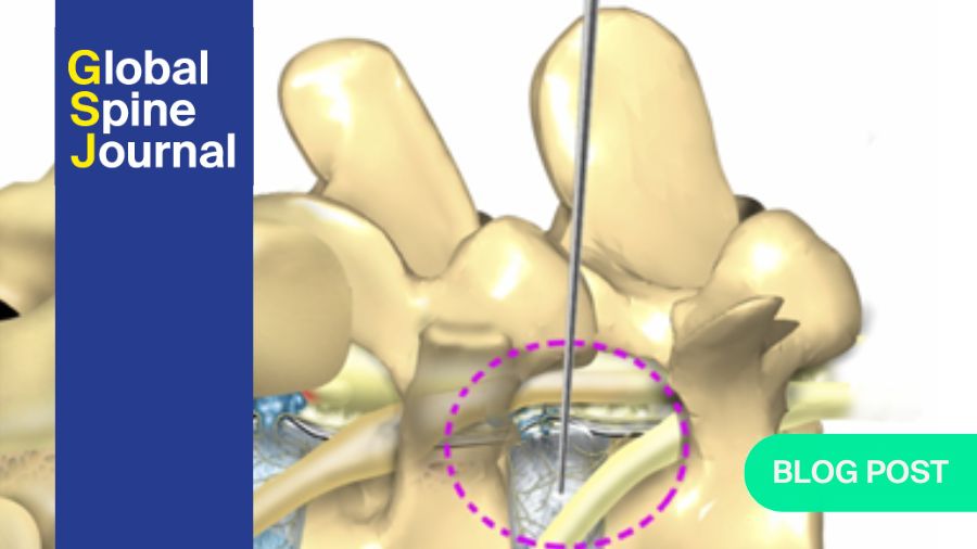 How good is trans-Kambin TLIF with a large-footprint interbody compared to ALIF?